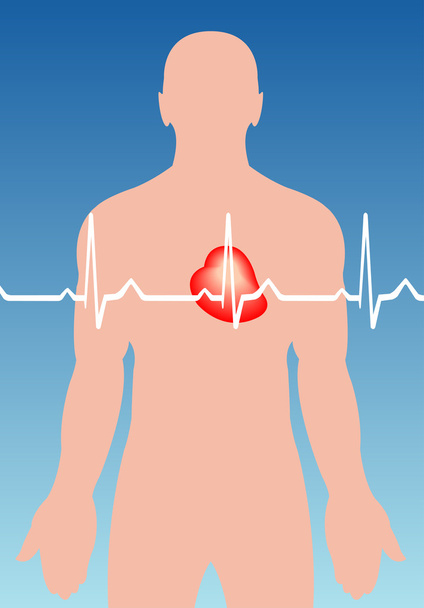 Arythmie cardiaque
 - Vecteur, image