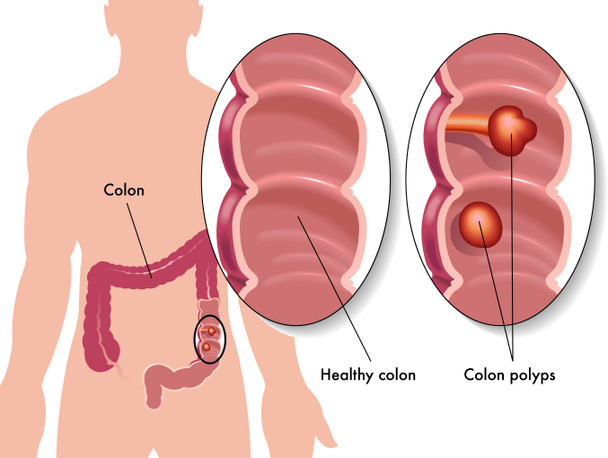 Pólipo de colon
 - Vector, imagen