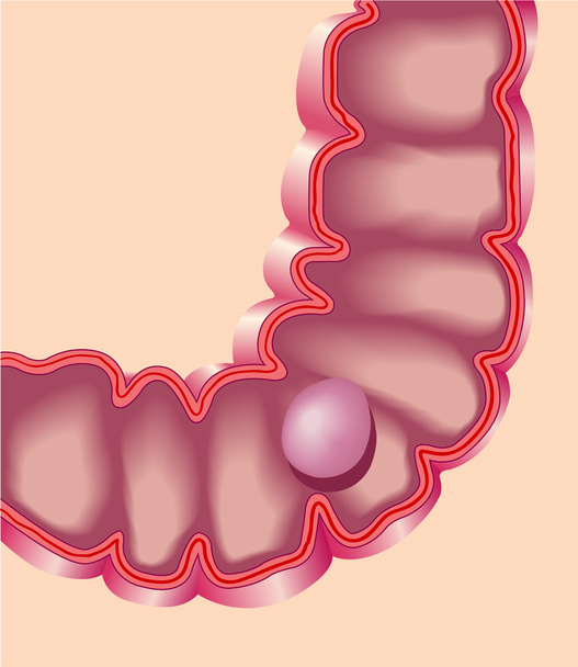 大腸ポリープ - ベクター画像