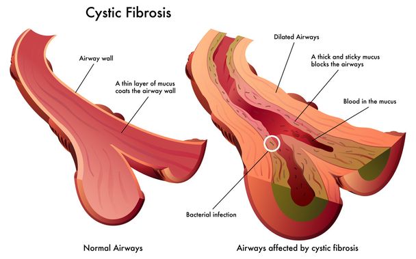 Cystická fibróza - Vektor, obrázek