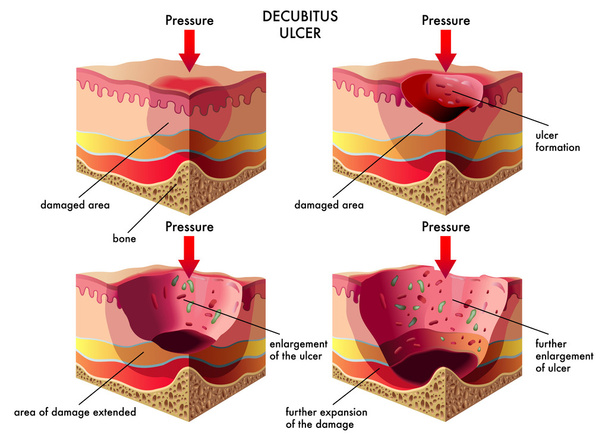 Úlcera de decubitus
 - Vector, imagen