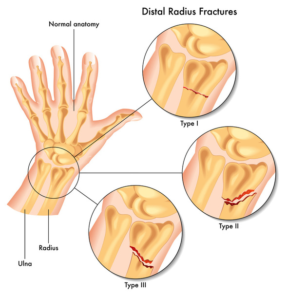 Fractures du rayon distal
 - Vecteur, image