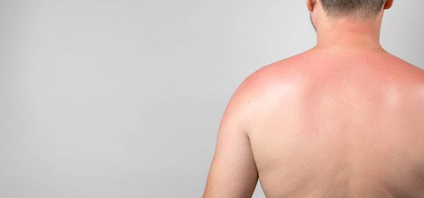 Back of a man with a sunburn, close-up, banner with space for text on gray - Foto, imagen
