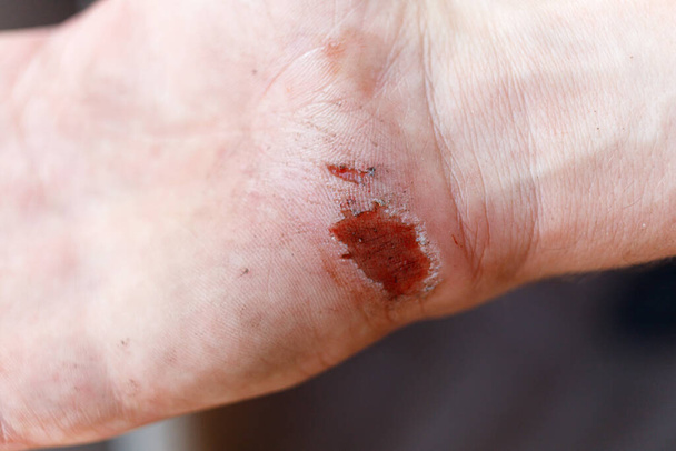 Πληγή στην παλάμη μετά από πτώση. Πρησμένο δέρμα στο χέρι. - Φωτογραφία, εικόνα