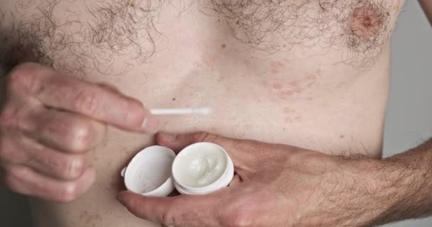 Man with a cotton swab lubricates a skin disease with an ointment from a jar. Pityriasis versicolor, self-treatment. Front view, indoors, naked torso. High quality 4k footage - Felvétel, videó