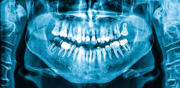 Women's panoramic dental radiograph, Orthopantomogram single panoramic image of the oral cavity with teeth showing different dental work. - Foto, Bild