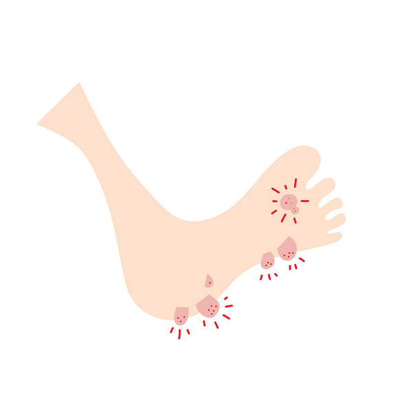 Plantar wart icon. Verruca symbol, foot corn, human papillomavirus sign, HPV infection, clavus pictogram, feet papilloma vector illustration - Vektör, Görsel
