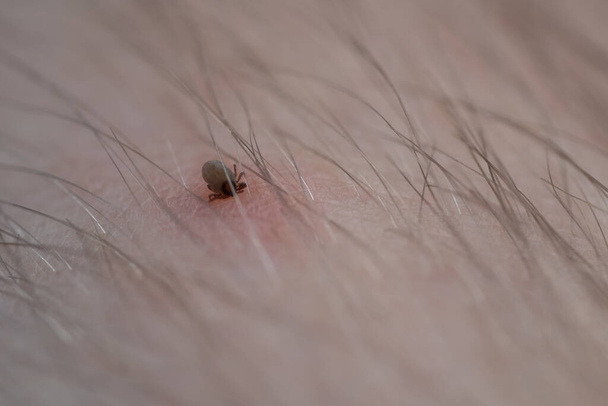Sucking a tick Macro photo on human skin. Ixodes ricinus. The swollen parasite has bitten the irritated pink epidermis. Small red drops. Dangerous insect mite. Encephalitis, Lyme disease infection. - Foto, imagen