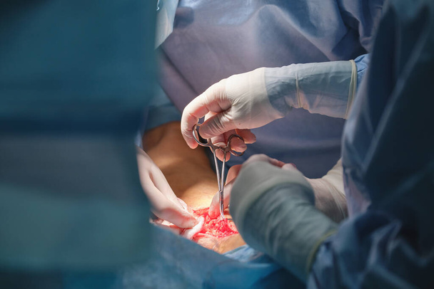 Close-up de médicos mãos operando um paciente realizando cirurgia de corte aberto na sala cirúrgica. Conceito de cuidados de saúde e intervenção médica. - Foto, Imagem