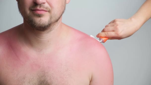 Applying therapeutic ointment to the skin of a person with a sunburn, close-up - Video