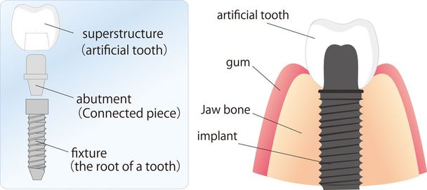 Εικονογράφηση της οδοντικό εμφύτευμα και τα στοιχεία - Διάνυσμα, εικόνα