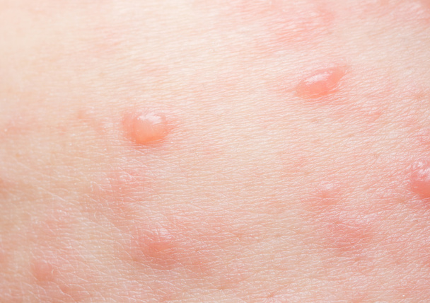 vesicular rash - Photo, Image