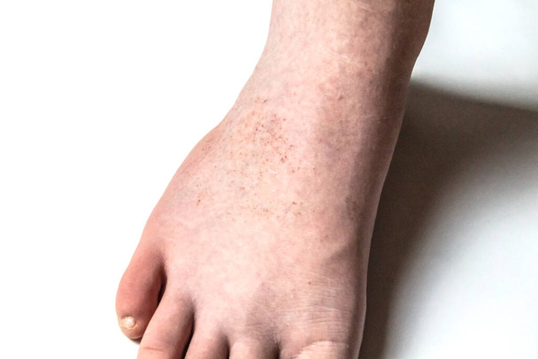 Шкіра з алергією, харчовою алергією, дерматитом, укусами комах, концепцією роздратування. Червоний висип на нозі чоловіка на білому тлі
. - Фото, зображення