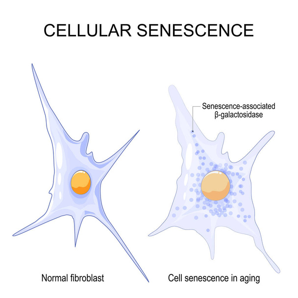 Cellular senescence. changes senescent cells During ageing. Comparison and difference between Normal fibroblast and Cell senescence in aging.  Vector illustration - Vektori, kuva