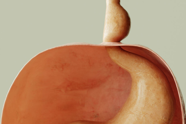 Axial hiatus hernia type 1 - entrance to the stomach via the diaphragm -- 3D rendering - Zdjęcie, obraz