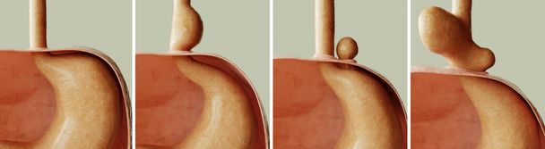 Hiatus hernia - Healthy and 3 types of diaphragmatic hernia -- 3D rendering - Zdjęcie, obraz
