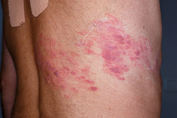 Skin lesion symptom in Shingles or Herpes zoster in human. Shingles or Herpes zoster is aviral disease caused by varicella zoster virus charatrized by a painful skin rash with blisters on the body. - Valokuva, kuva