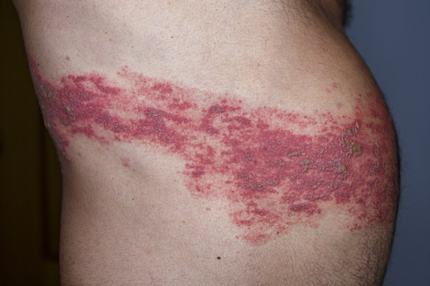 Skin lesion symptom in Shingles or Herpes zoster in human. Shingles or Herpes zoster is aviral disease caused by varicella zoster virus charatrized by a painful skin rash with blisters on the body. - Fotó, kép