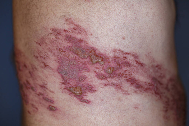 Skin lesion symptom in Shingles or Herpes zoster in human. Shingles or Herpes zoster is aviral disease caused by varicella zoster virus charatrized by a painful skin rash with blisters on the body. - Photo, image