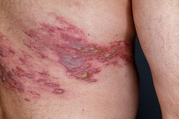 Skin lesion symptom in Shingles or Herpes zoster in human. Shingles or Herpes zoster is aviral disease caused by varicella zoster virus charatrized by a painful skin rash with blisters on the body. - Foto, Imagen