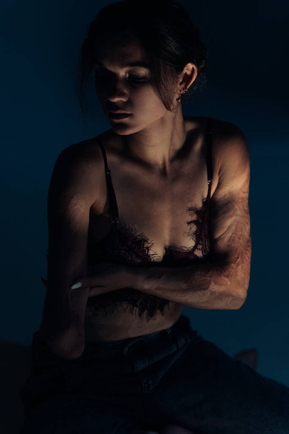 Beautiful young woman with amputee arm and scars from burn on her body poses in lacy bra. The concept of a fulfilling life of persons with disabilities. - Foto, immagini