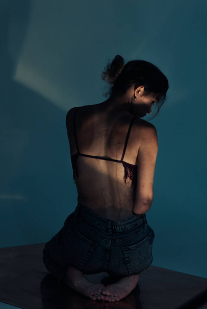 Beautiful young woman with amputee arm and scars from burn on her body poses in lacy bra. The concept of a fulfilling life of persons with disabilities. Back view. - 写真・画像