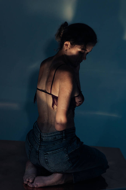 Beautiful young woman with amputee arm and scars from burn on her body poses in lacy bra. The concept of a fulfilling life of persons with disabilities. Back view. - 写真・画像
