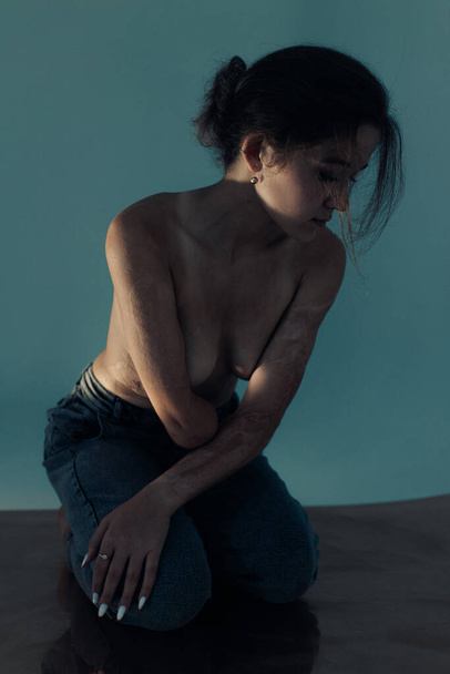 Beautiful young woman with amputee arm and scars from burn on her body poses topless. The concept of a fulfilling life of persons with disabilities. - Photo, Image