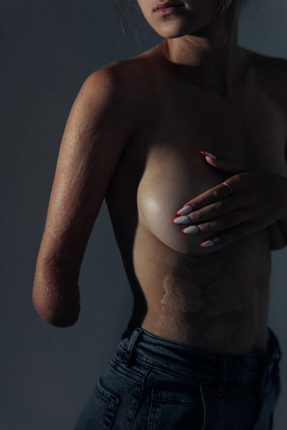 Beautiful young woman with amputee arm and scars from burn on her body poses topless. The concept of a fulfilling life of persons with disabilities. Closeup. - 写真・画像