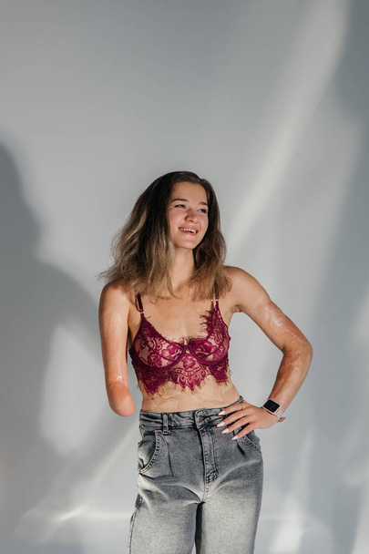 Smiling young woman with amputee arm and scars from burn on her body poses in lacy bra. The concept of a fulfilling life of persons with disabilities. - Fotografie, Obrázek