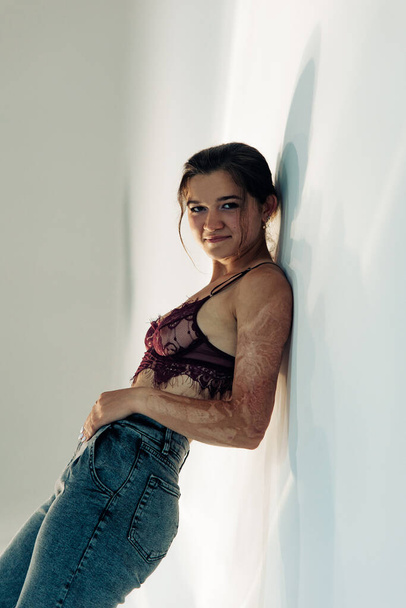 Smiling young woman with amputee arm and scars from burn on her body poses in lacy bra. The concept of a fulfilling life of persons with disabilities. - 写真・画像