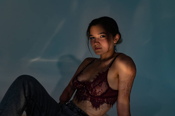 Beautiful young woman with amputee arm and scars from burn on her body poses in lacy bra. The concept of a fulfilling life of persons with disabilities. - 写真・画像