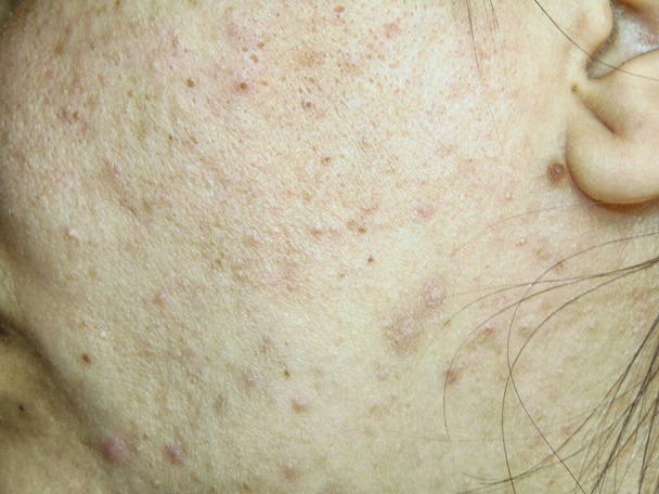 Woman with pimples on her face. Woman with acne skin - Foto, Imagem