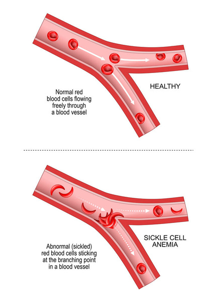 Sickle cell disease. SCD is a disorder inherited from a person's parents. anaemia, or anemia. Comparison and difference between blood vessel and erythrocytes of healthy person and abnormal red blood cells sticking at the branching point In a blood ve - Vektor, obrázek