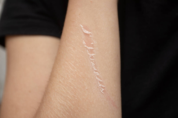 An abrasion on the arm. scratched skin on the arm. - Photo, Image