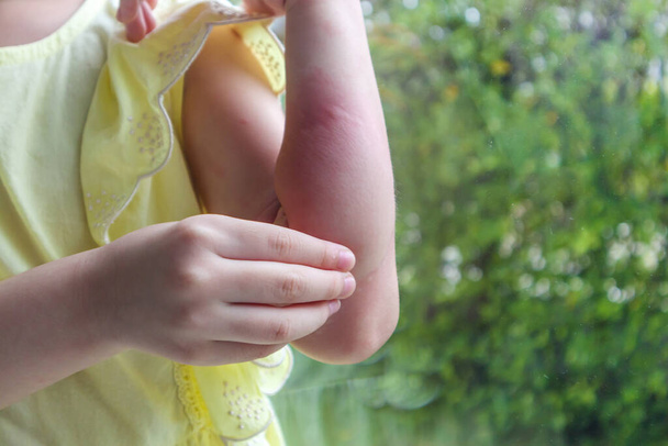 A kislány bőrkiütéses allergiás és viszket a karja. - Fotó, kép