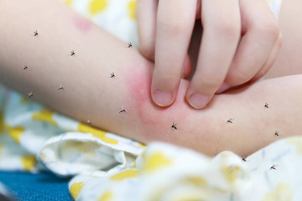Mała dziewczynka ma alergię na wysypkę skórną i swędzi się na ramieniu od ugryzienia komara - Zdjęcie, obraz