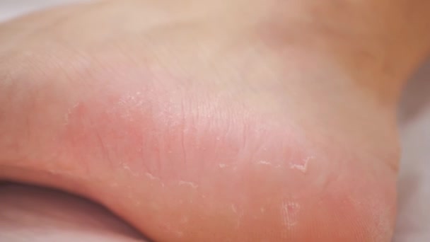 fungus on womens legs. Chiropody. Isolated video close-up - Footage, Video