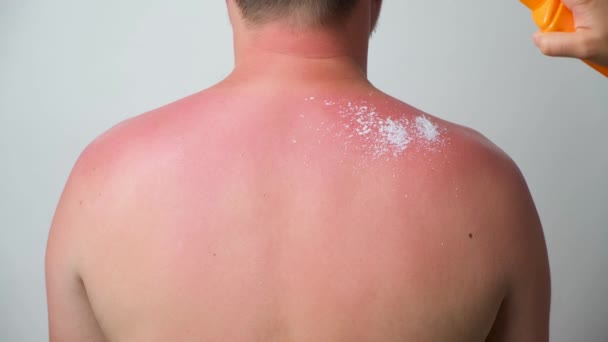 The process of applying a therapeutic cream to a sunburn on the skin of a man - Video