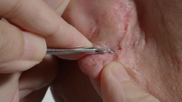 Behandelingsbeelden van acne. Squeezing blackhead puist met roestvrij staal medische acne remover tool. Blackhead puistjes uit de oorlel drukken en verwijderen. Acne huidprobleem close-up huidverzorging concept. - Video