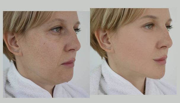 γυναίκα διπλό πηγούνι πριν και μετά τη θεραπεία - Φωτογραφία, εικόνα