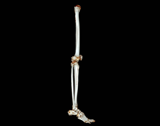 CT scan of lower extremity  3D for diagnosis fracture of Femur bone , knee joint , leg and foot 3D rendering - Photo, image