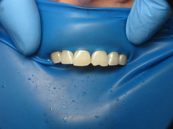 dental treatment at the dentist. filling problematic teeth. special elastic pad on the gums to protect against drops. cofferdam on the teeth - Photo, Image