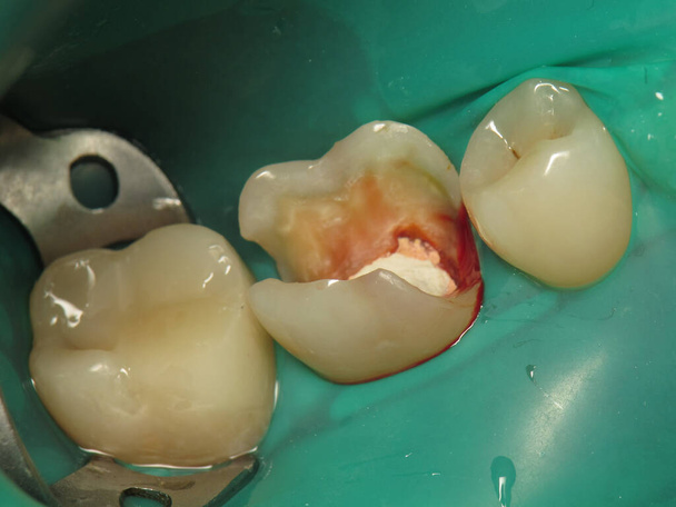 лечение зуба с отверстием у стоматолога. гнилой зуб изнутри во рту человека. процедура лечения забытого зуба - Фото, изображение