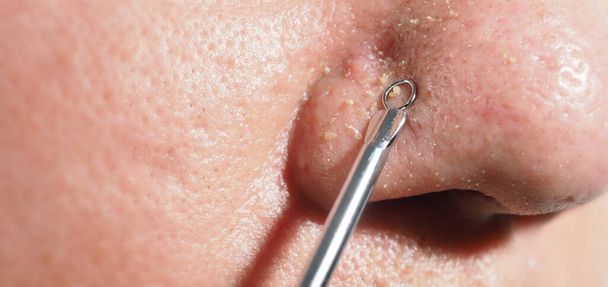 Acne en probleemporiën. Squeezing blackhead puist met roestvrij staal medische acne remover tool. Blanke puistjes uit neusporiën. Acne huidprobleem close-up. huidverzorging. - Foto, afbeelding