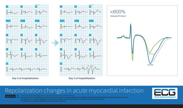 In acute myocardial infarction, the dynamic change of repolarization and prolongation of QT interval are the hallmarks of torsade de pointes. - Photo, Image
