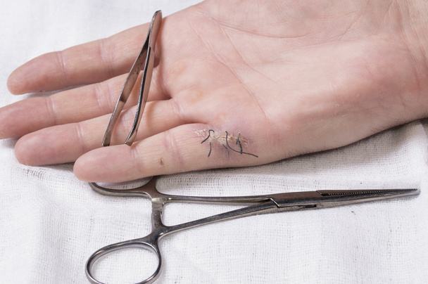 Blessure avec points de suture sur la main des hommes avec du matériel médical
 - Photo, image