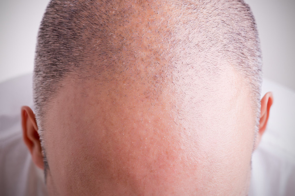 Потеря волос - Фото, изображение