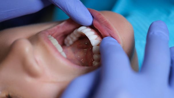 Zahnarzt, der die Mundhöhle des Patienten mit Veneers Nahaufnahme untersucht. Installation von Verbund- und Zirkonfurnieren - Foto, Bild
