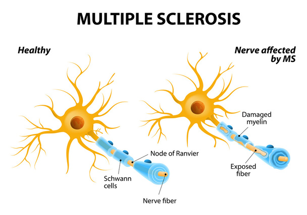 Multiple Sklerose - Vektor, Bild
